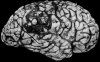 Arteriovenous malformation, lateral surface of brain